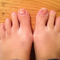 FootWorks Podiatry & Laser - This picture was taken in October 2012 - so much improvement!! Especially the right big toe!
