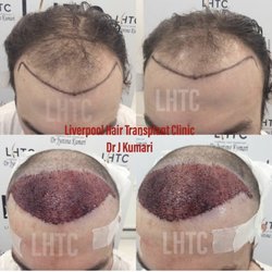 Liverpool Hair Transplant Clinic - Hair Transplant by Dr Kumari