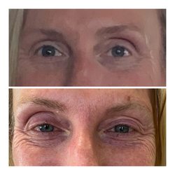 The Skin Lounge - Plasma pen before and after 8 days