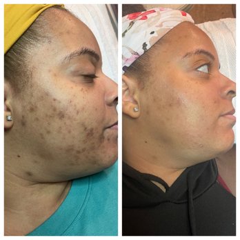 Skincare By Lori - Acne and scarring almost completely gone! Only up from here - Skin Care Near Me - Newport Beach, California Skincare By Lori - Acne and scarring almost completely gone! Only up from here - Skin Care Near Me - Newport Beach, California