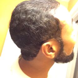 Bosley Hair Restoration & Transplant - After.
