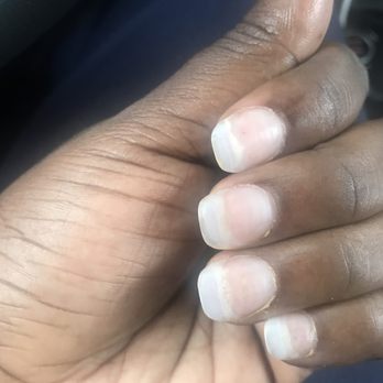 TM Nail Spa - Crappy acrylic job I was left with - Nail Salons Near Me - Alexandria, Virginia TM Nail Spa - Crappy acrylic job I was left with - Nail Salons Near Me - Alexandria, Virginia