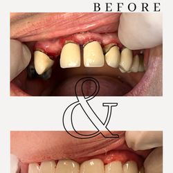 Keen Family Dentistry - Anterior Zirconia Crowns and Anterior Zirconia Bridge Completed by Dr. Bryce Keen