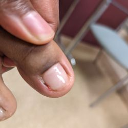 Generation Nails - Toe inury