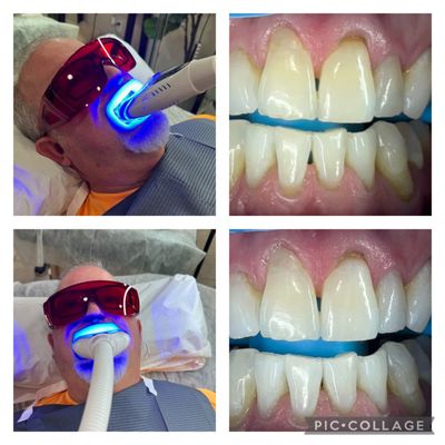 Great Before and After Results - Pearland Professional and customized IN-office Teeth Whitening with little to no sensitivity! Safe/FDA approved. Results! Great Before and After Results - Pearland Professional and customized IN-office Teeth Whitening with little to no sensitivity! Safe/FDA approved. Results!