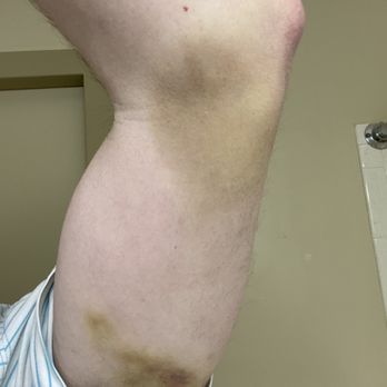UNC REX Healthcare - Injuries sustained after being assaulted by UNC Rex "security guards" after I called them for help. - Urgent Care Near Me - Raleigh, North Carolina