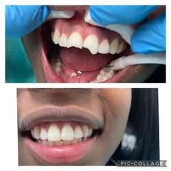 Leslie Azran, DDS - BH Dental - Composite veneer used to repair broken teeth
