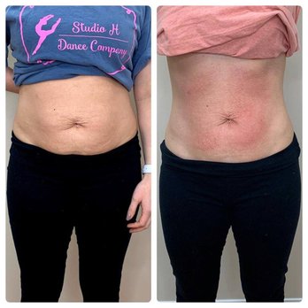 Karmic Grace - We also offer Neveskin. This is a non-invasive cool therapy technique that firms, tightens, tones, and reduces body's inflammatory response. - Massage Therapy Near Me - Ketchum, Idaho