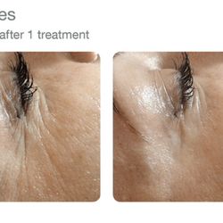 Essential Elements Wellness - Before & after 1 treatment with our Elapomed system.