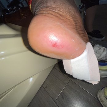MC Prime Nail Spa salon - Wound at the bottom of my right foot. - Nail Salons Near Me - Brooklyn, New York