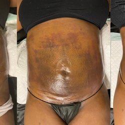 Renue Beauty Bar - Progress of my lymphatic massages