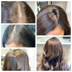 Studio LV - Suffering from an auto immune disease causing hair loss. Hairdreams MicroLines helped her achieve thicker and more voluminous hair.