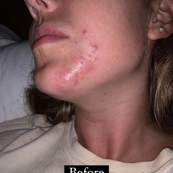 Source - Before treatment began - Acupuncture Near Me - San Diego, California Source - Before treatment began - Acupuncture Near Me - San Diego, California