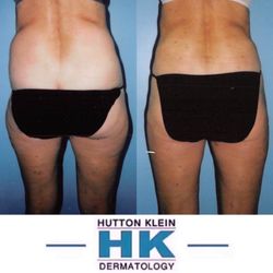 KleinLipo - Tumescent Liposuction B/A of the Hips and Outer Thighs by Dr. Jeffrey Klein at HK Dermatology.