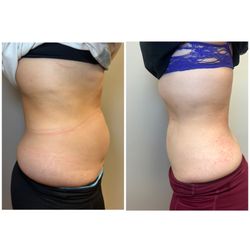 Beverly Hills Lux Body and Aesthetics - 4 trio sessions