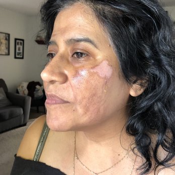 Zen Spa Aesthetics - After my facial. My face is burning and I'm a lot pain. She said it's normal. - Permanent Makeup Near Me - Torrance, California Zen Spa Aesthetics - After my facial. My face is burning and I'm a lot pain. She said it's normal. - Permanent Makeup Near Me - Torrance, California