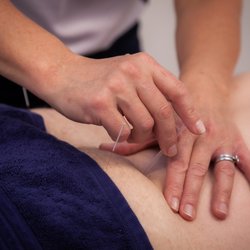 City Physiotherapy & Sports Injury Clinic - Adelaide Physio Dry Needling
