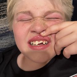 Santa Clarita Valley Dental Care - Chipped teeth