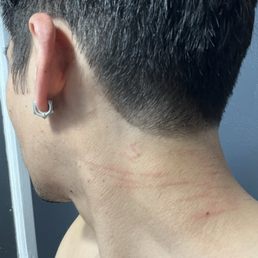 Burn marks almost cuts from Danny's clipper and being too rough Burn marks almost cuts from Danny's clipper and being too rough
