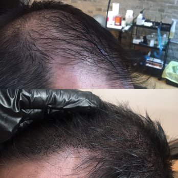 CustomScalp - Hair Loss Centers Near Me - Greenfield, Wisconsin CustomScalp - Hair Loss Centers Near Me - Greenfield, Wisconsin