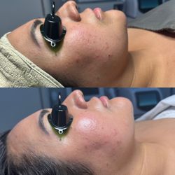 Skin barrier compromised with breakouts (before)
Hydrated, glowing clean skin (after)