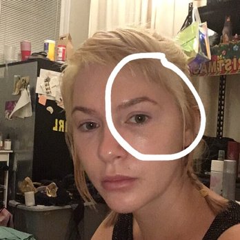MiracleFace MedSpa - Undereye - Medical Spas Near Me - New York, New York