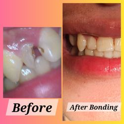Plum Point Dental - Bonding Results - Before and After