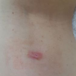 Sydney CBD Medical Centre - 3 weeks later!!! I complained they werent stitched properly and was only patronised!!! Now look!!
