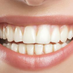 In A Day Smile Dental Implant Centers