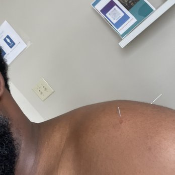 TheraCave Physical Therapy - Dry Needle - Physical Therapy Near Me - Fort Lauderdale, Florida TheraCave Physical Therapy - Dry Needle - Physical Therapy Near Me - Fort Lauderdale, Florida