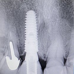 Smile Bright Family Dentistry - Newman - Implant to restore missing tooth
