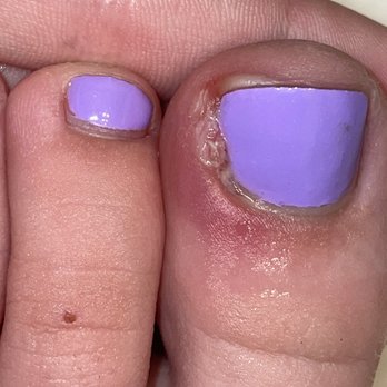 Luxury Nails & Spa - Infected toenail. - Nail Salons Near Me - Olympia, Washington Luxury Nails & Spa - Infected toenail. - Nail Salons Near Me - Olympia, Washington