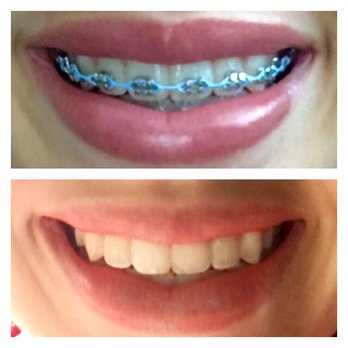 Brenn Orthodontics - Before and after the day the braces actually came off - Orthodontists Near Me - Burbank, California