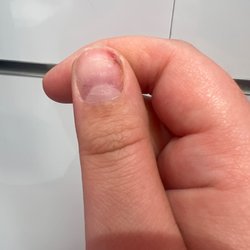 Mv Nails - Result of improper acrylic nail removal