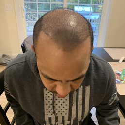 Day 9 after procedure