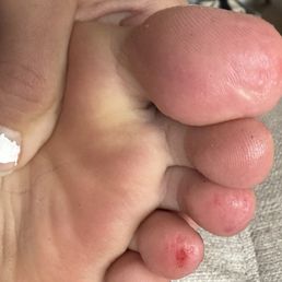 Pedicure damaged foot Pedicure damaged foot