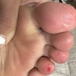Ridgeline Nail - Pedicure damaged foot