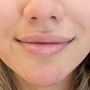 Physicos Aesthetics - After. I got 0.5 syringe- Juvederm - Medical Spas Near Me - Walnut Creek, California Physicos Aesthetics - After. I got 0.5 syringe- Juvederm - Medical Spas Near Me - Walnut Creek, California