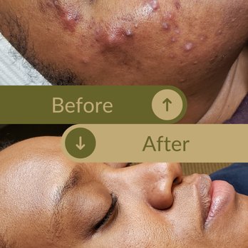 Complexions Clinical Skincare - Before: painful cysts. After: calm, clear skin with faded redness and renewed confidence. - Waxing Near Me - Toledo, Ohio Complexions Clinical Skincare - Before: painful cysts. After: calm, clear skin with faded redness and renewed confidence. - Waxing Near Me - Toledo, Ohio