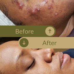 Complexions Clinical Skincare - Before: painful cysts. After: calm, clear skin with faded redness and renewed confidence.