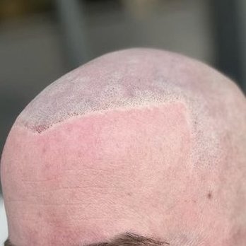 Consuelo Sierra - Scalp Micropigmentation hairline - Permanent Makeup Near Me - Denver, Colorado Consuelo Sierra - Scalp Micropigmentation hairline - Permanent Makeup Near Me - Denver, Colorado