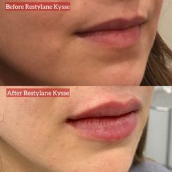 Beauty Religion - Before and after Restylane Kysse for lip enhancement