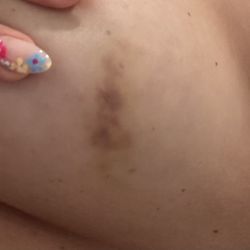 Houston Behavioral Healthcare Hospital - Bruises from this facility