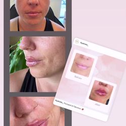 iHydrate Wellness & Aesthetics - Beautiful "Russian Lip" style lips Lip filler can help hydrate and enhance the look of your lips #Russianlip #lipfiller #chicagolips