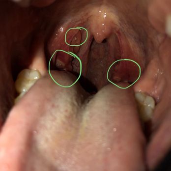 Chesapeake ERgent Care - Obvious NOT perfect throat that's red with white patches - Urgent Care Near Me - Gambrills, Maryland Chesapeake ERgent Care - Obvious NOT perfect throat that's red with white patches - Urgent Care Near Me - Gambrills, Maryland