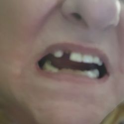 Hurd Family Dental - This is why I missed the holiday season of 2024. Because he could not get my crown to stay attached to no existing tooth.