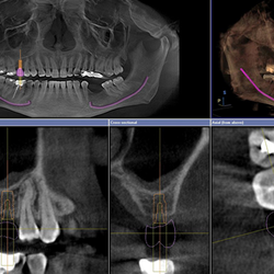 Dental Image - 3D CT Scan, for digital planning of dental implant placement with precise measurements.