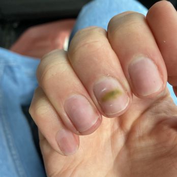 Modern Spa - Green Nail Syndrome to to improper filling - Nail Salons Near Me - New York, New York Modern Spa - Green Nail Syndrome to to improper filling - Nail Salons Near Me - New York, New York