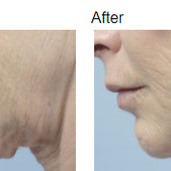 Symmetry Medspa - Case #113 - Facetite FaceTite2 Individual results may vary. - Medical Spas Near Me - Montgomery, Alabama Symmetry Medspa - Case #113 - Facetite FaceTite2 Individual results may vary. - Medical Spas Near Me - Montgomery, Alabama