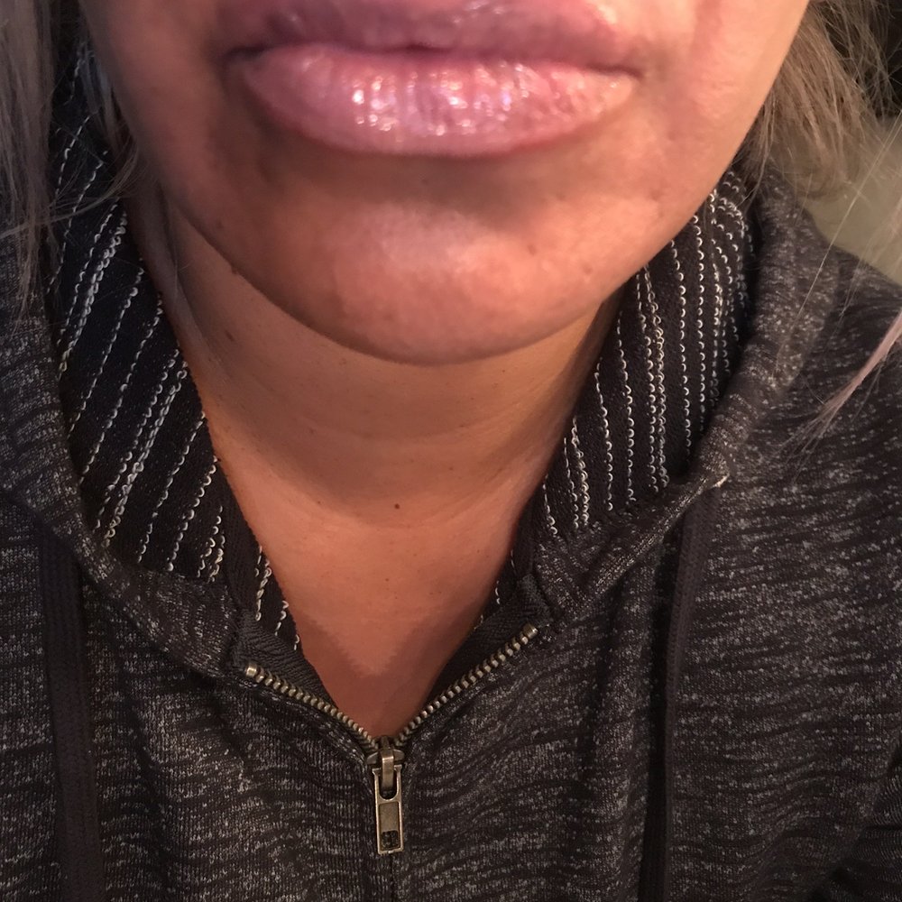 Steven K Struck, MD - After Lip Filler - Cosmetic Surgeons Near Me - Atherton, California Steven K Struck, MD - After Lip Filler - Cosmetic Surgeons Near Me - Atherton, California